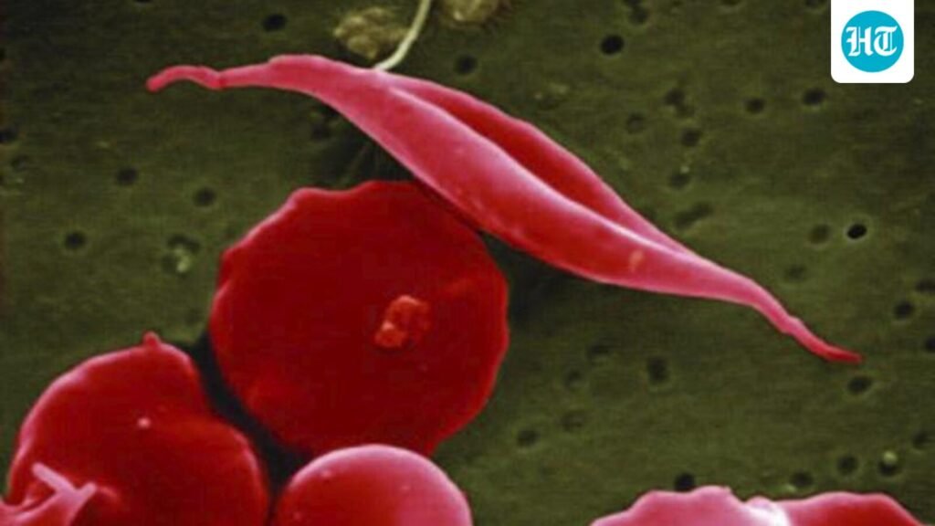 maharashtra-using-tribal-languages-to-spread-awareness-on-sickle-cell-disease