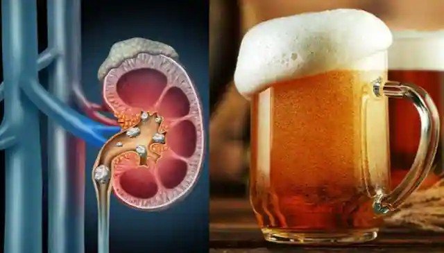 Can Beer Really Help Remove Kidney Stones? Doctors Reveal The Truth